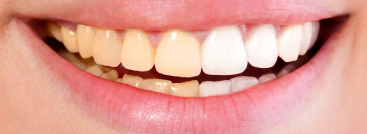 تغییر رنگ دندان| هدی دنت