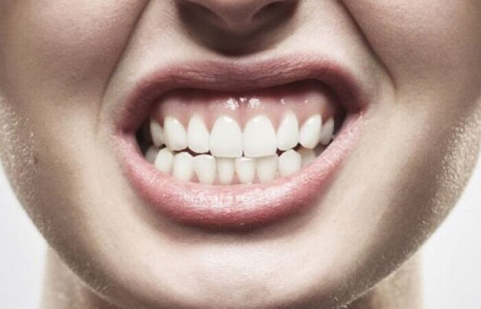 دندان قروچه| هدی دنت
