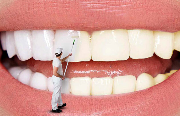 بلیچینگ دندان | هدی دنت