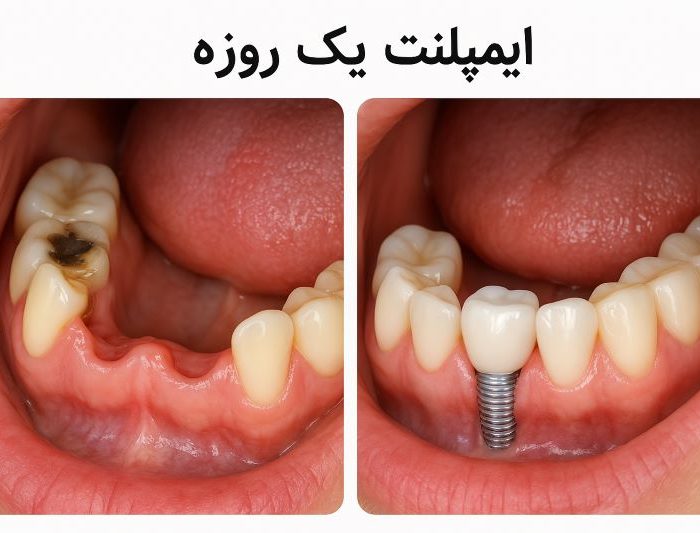 ایمپلنت یک روزه
