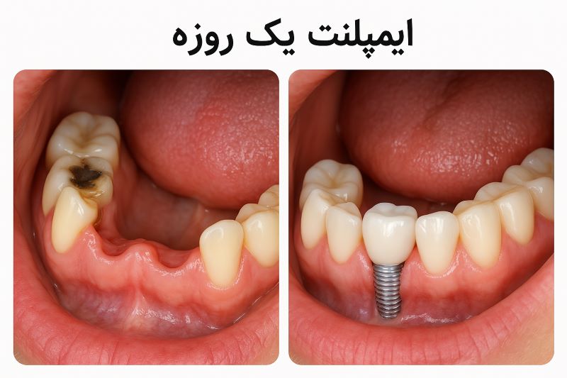 ایمپلنت یک روزه
