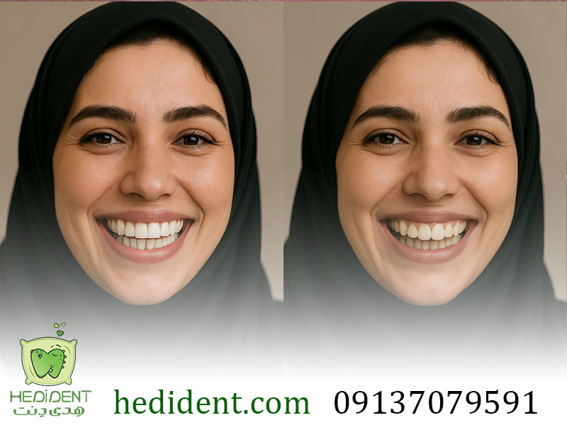 عکس قبل و بعد کامپوزیت دندان