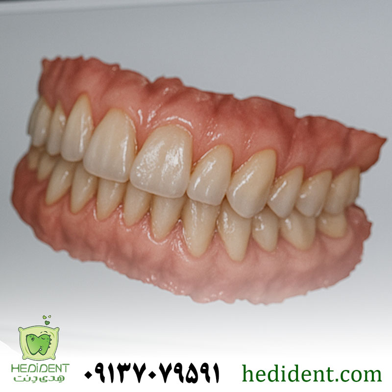 قالب‌گیری دیجیتال دندان