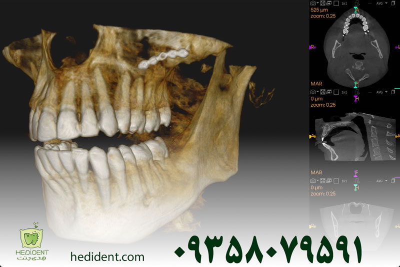 عکس CBCT دندان چیست؟