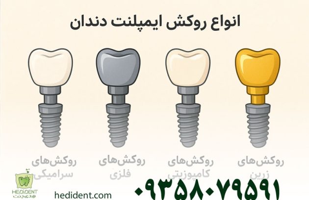 انواع روکش ایمپلنت دندان: راهنمای کامل با مزایا و معایب