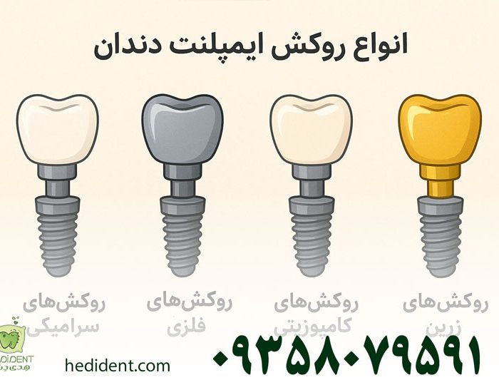 انواع روکش ایمپلنت دندان: راهنمای کامل با مزایا و معایب