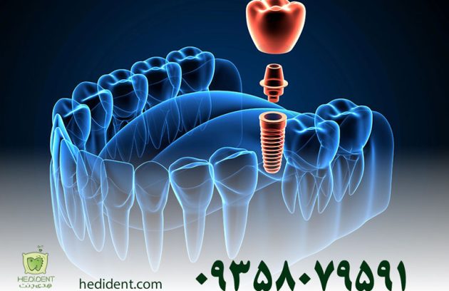 تفاوت ایمپلنت دیجیتال با ایمپلنت معمولی؛ ۵ دلیل برای انتخاب بهترین گزینه
