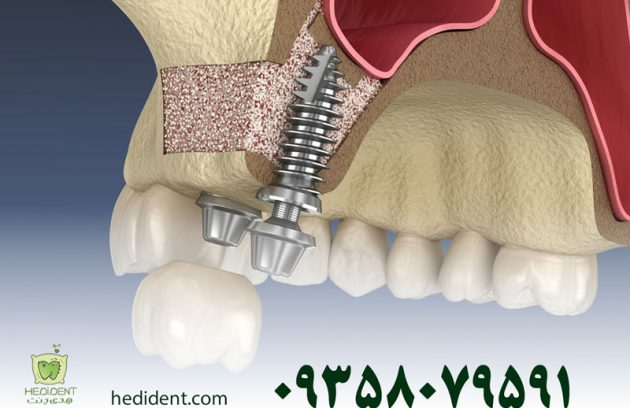 جراحی سینوس لیفت چیست؟ هزینه و مراحل آن