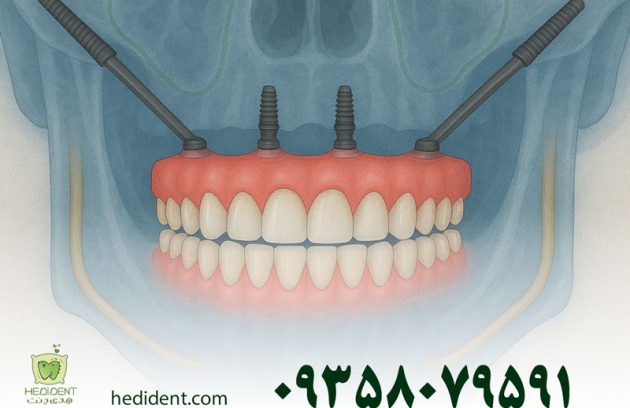 روش‌های انجام ایمپلنت زیگوماتیک