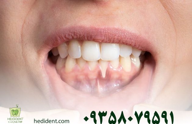 علت سیاه شدن لثه چیست و چگونه می‌توانیم آن را درمان کنیم