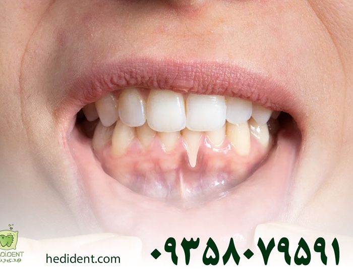 علت سیاه شدن لثه چیست و چگونه می‌توانیم آن را درمان کنیم
