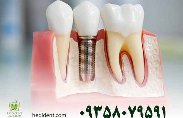 فرق ایمپلنت و لمینت: کدام یک برای شما مناسب‌تر است؟