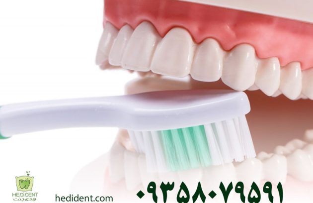 مسواک زدن بعد از ایمپلنت دندان چگونه است؟