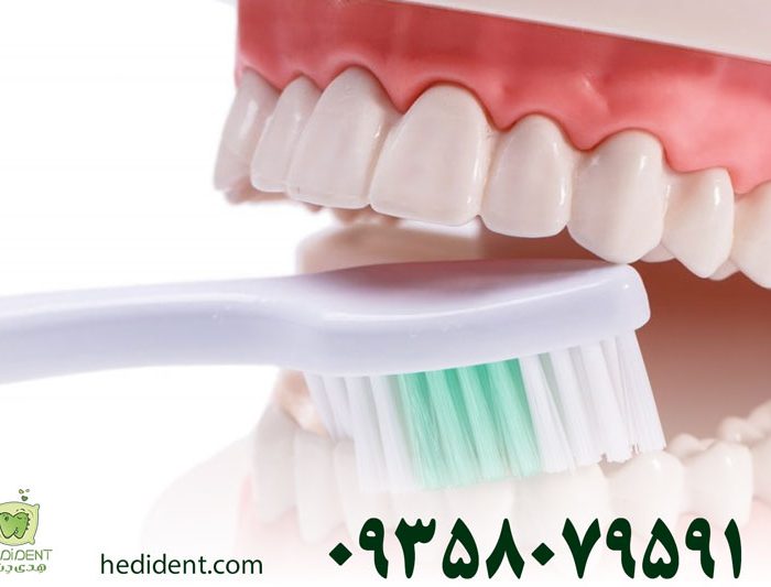 مسواک زدن بعد از ایمپلنت دندان چگونه است؟