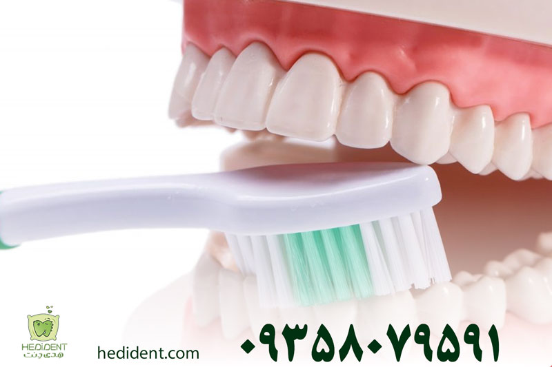 مسواک زدن بعد از ایمپلنت دندان چگونه است؟