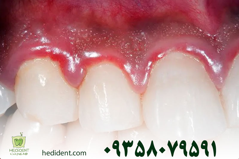 پیشگیری از سیاه شدن لثه